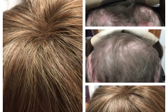 Hair System - Before and After